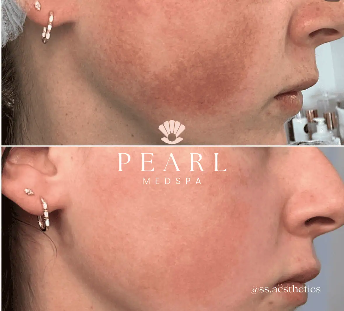 Chemical Peel Treatment-Before-After