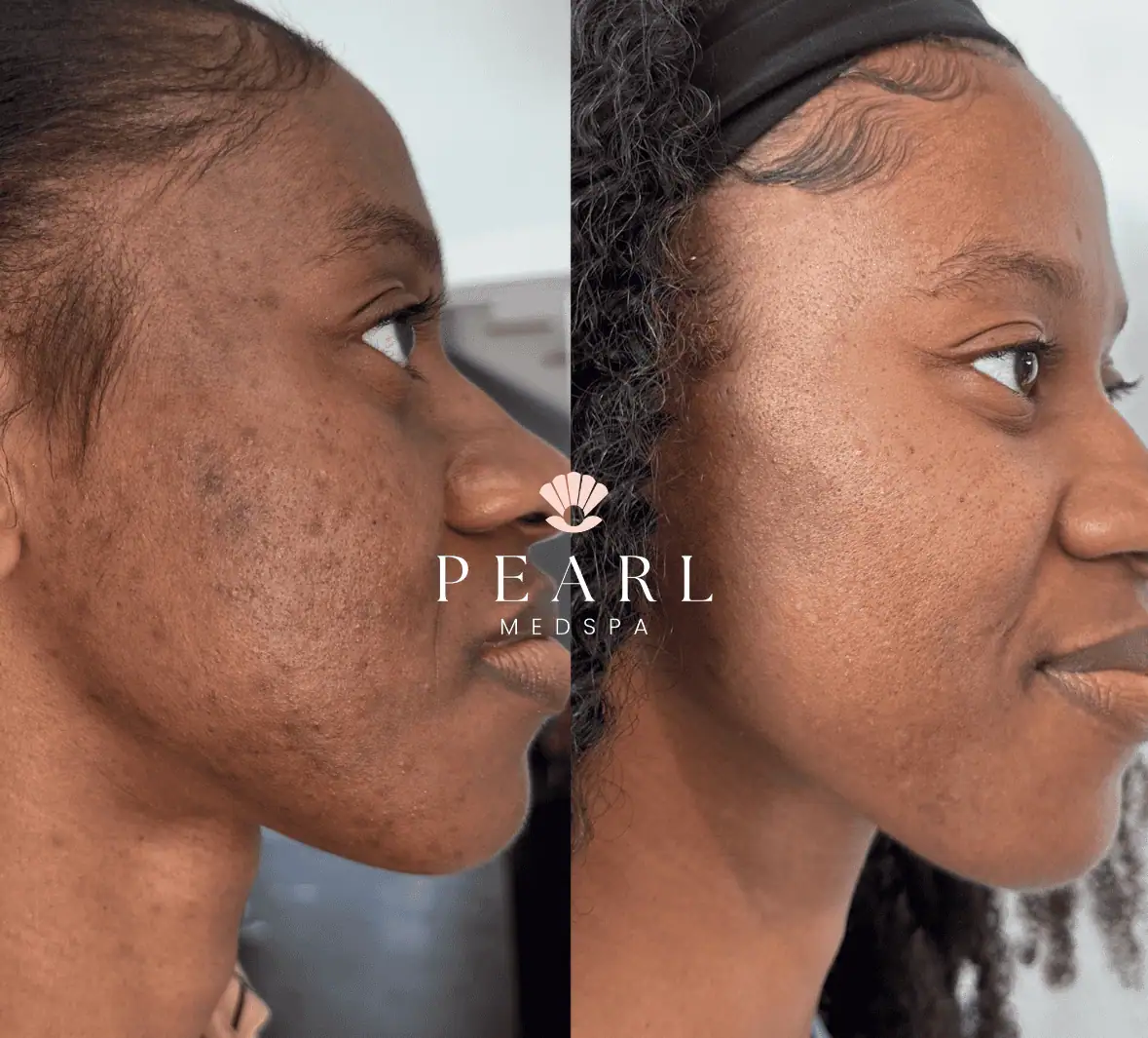 Chemical Peel Treatment-Before-and-after