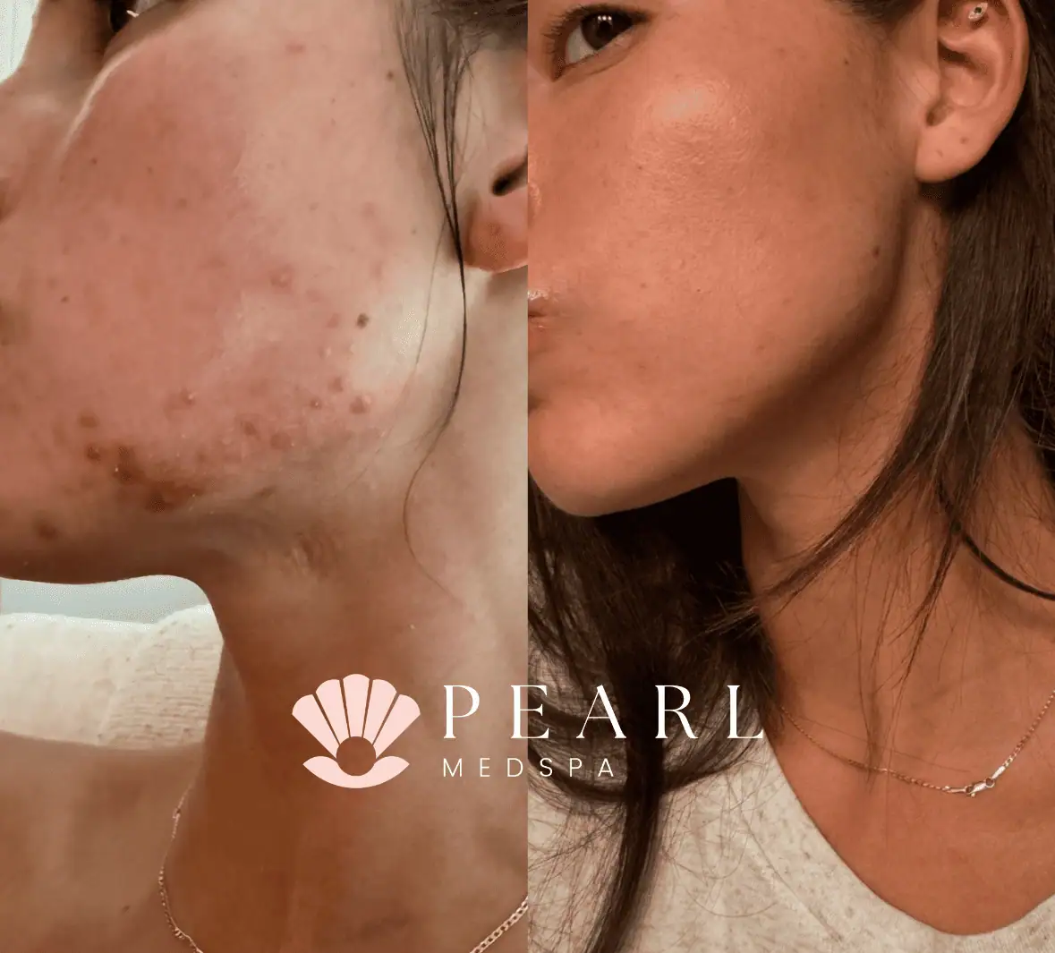Chemical Peel Treatments-Before-After