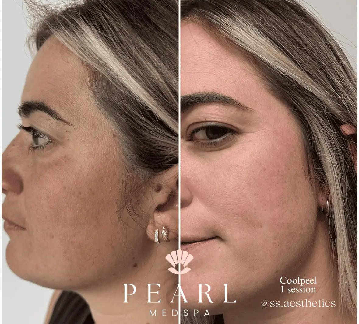 CoolPeel-Co2-Before-After