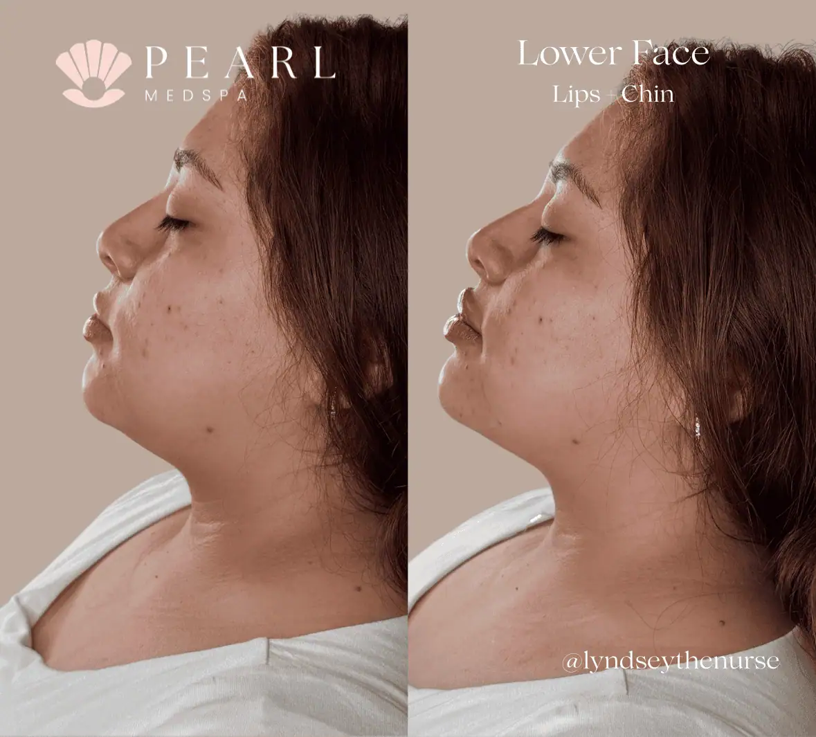 Dermal-Filler-Before-After