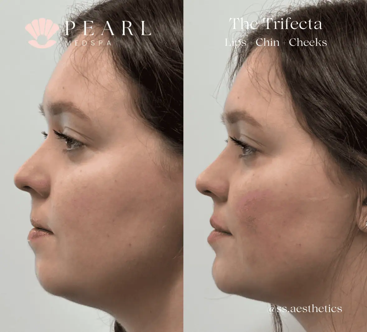 Dermal-Fillers-Before-After