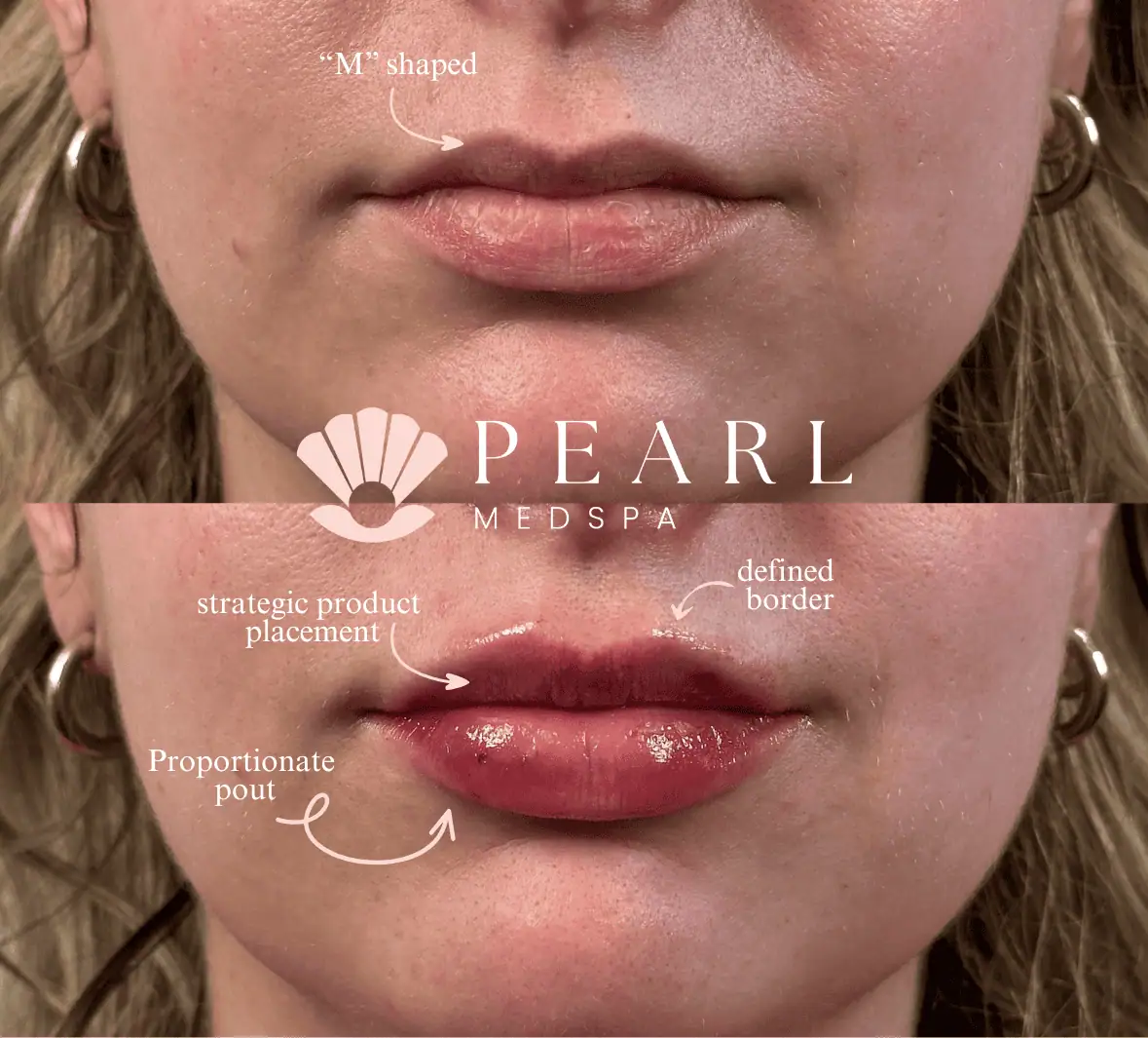 Filler-Before-After