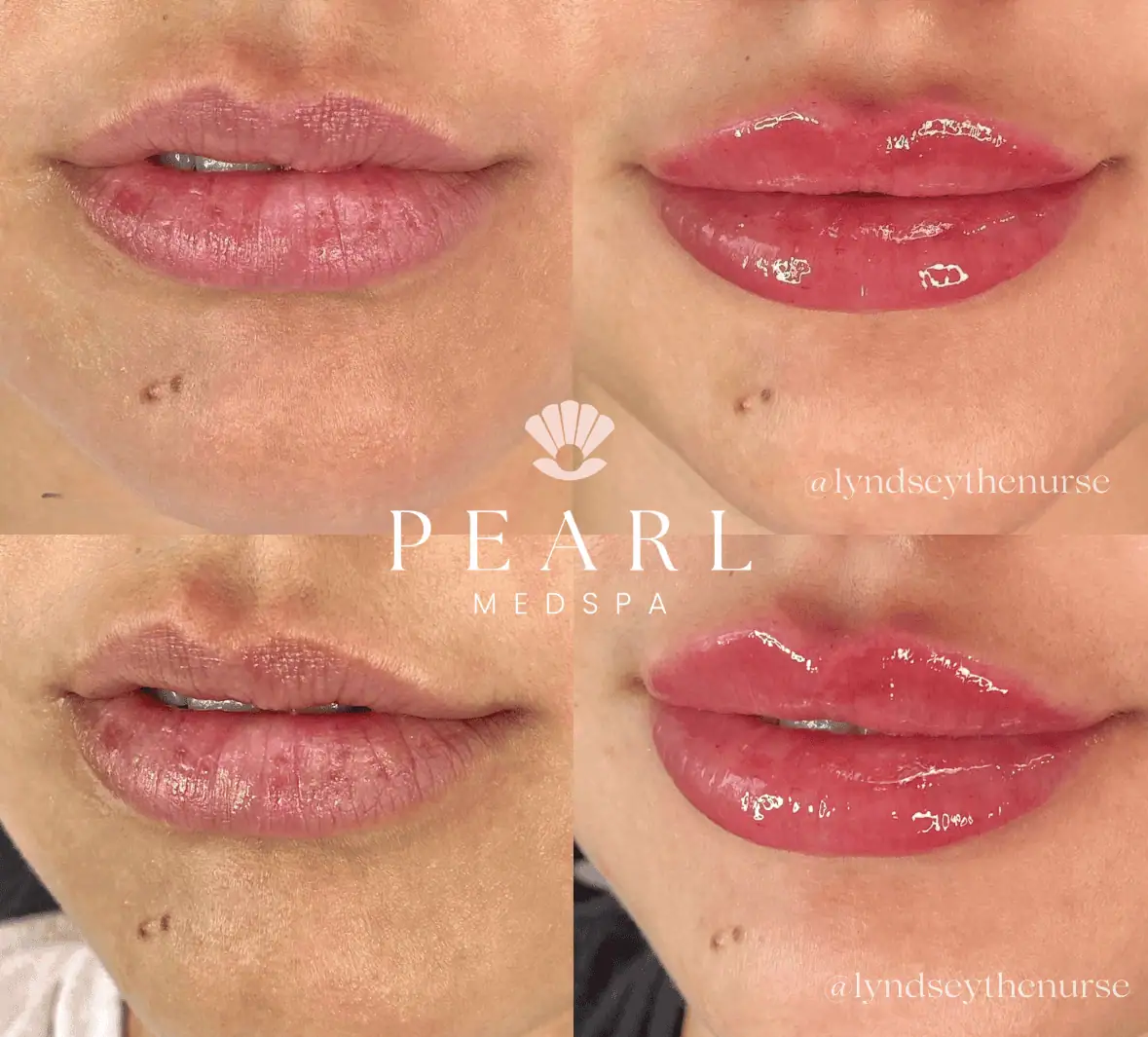 Fillers-Before-After