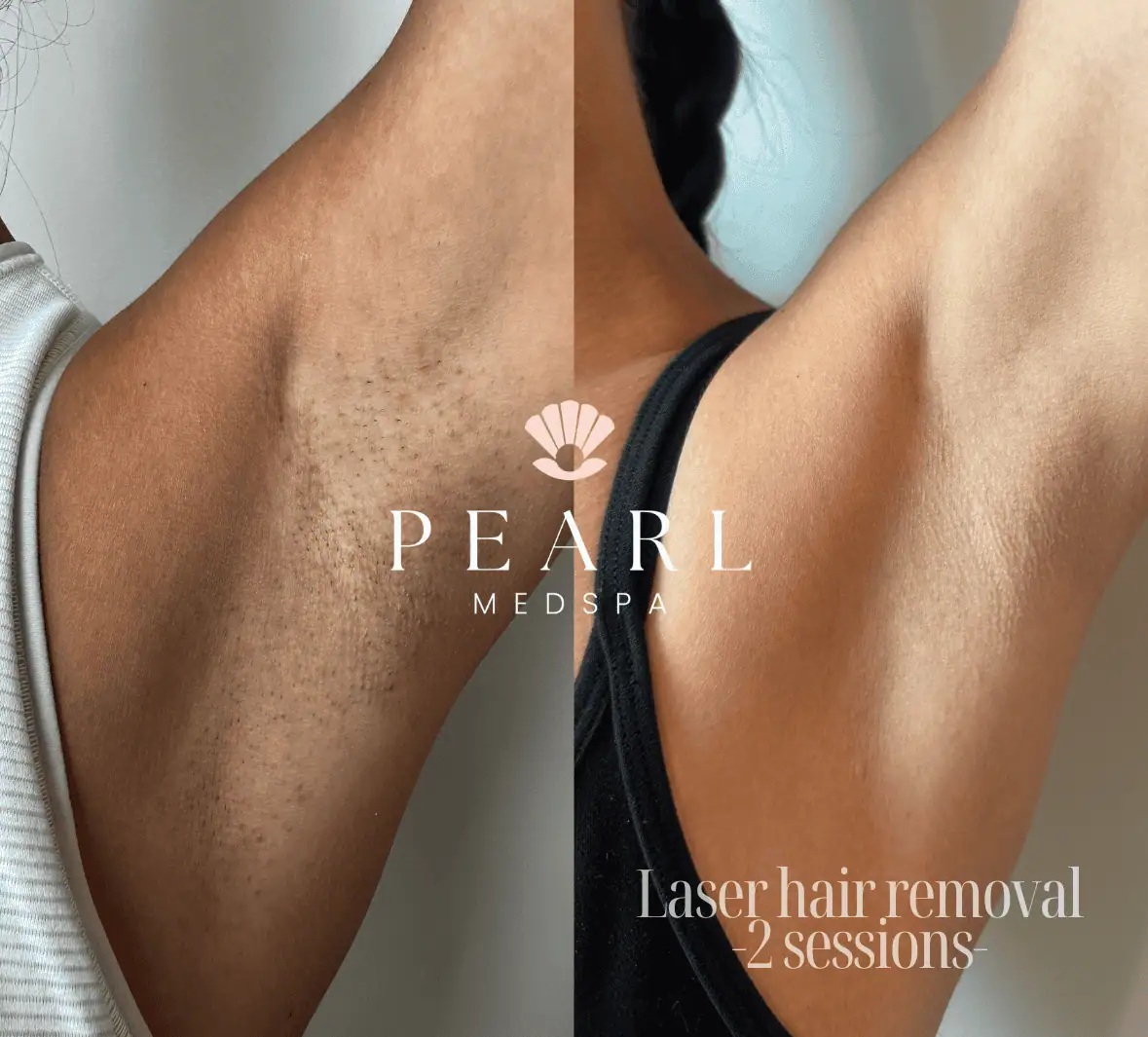 Laser-Hair-Removal-Before-After