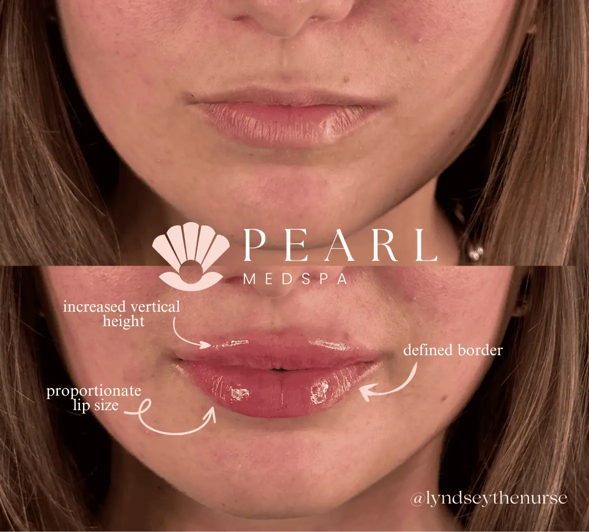 Lip-Filler-Before-After