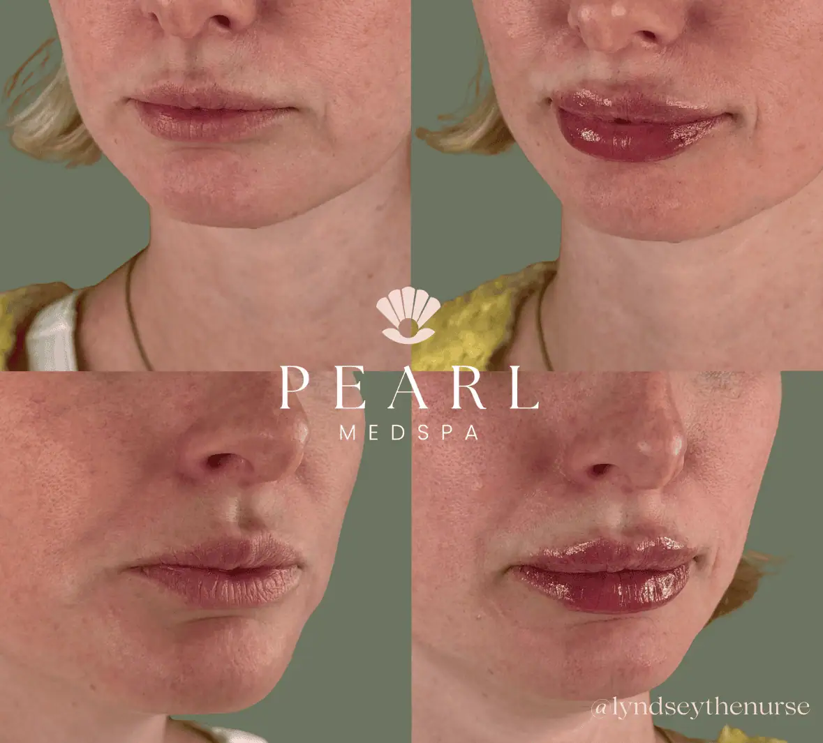 Lip-Filler-Before-and-after