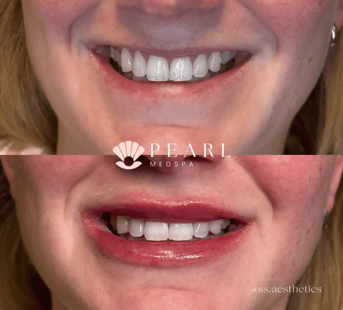 Lip-Filler-Treatment-Before-After