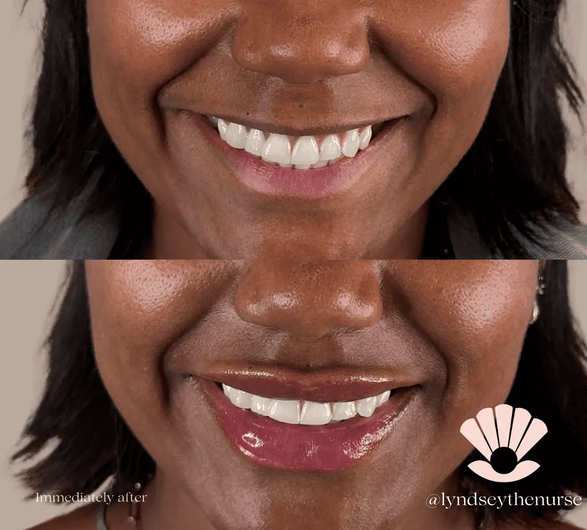 Lip-Fillers-Before-and-After