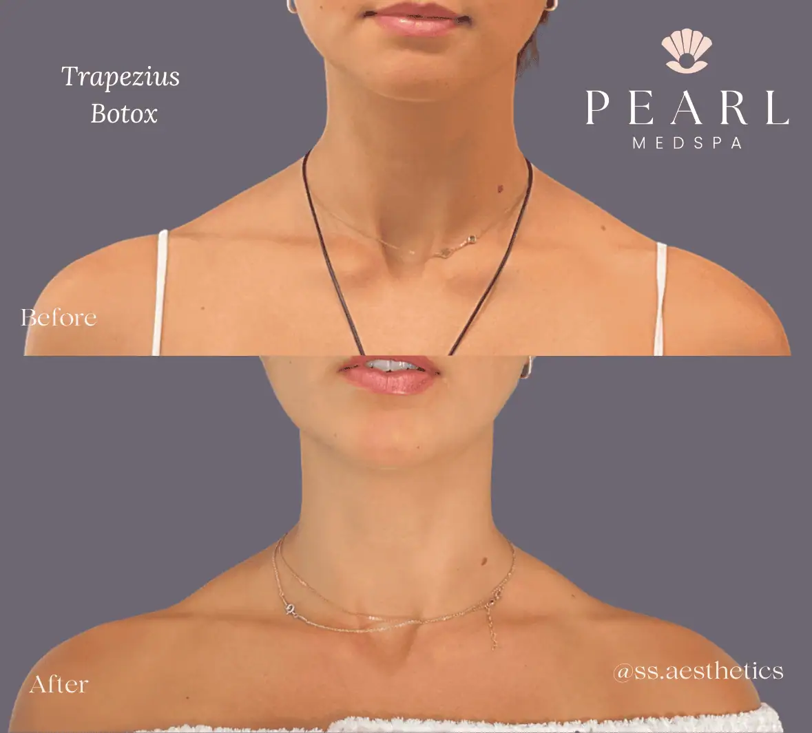 Neuromodulators-Before-After