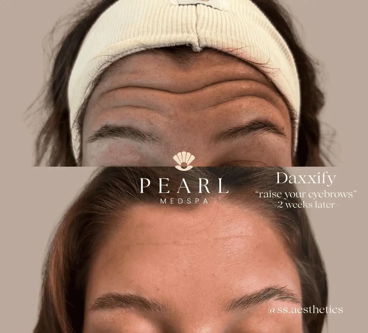 Neuromodulators-Before-Afters