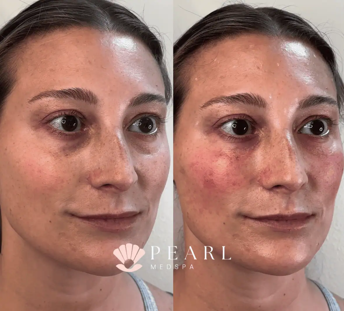 PRP-Gel-Before-After