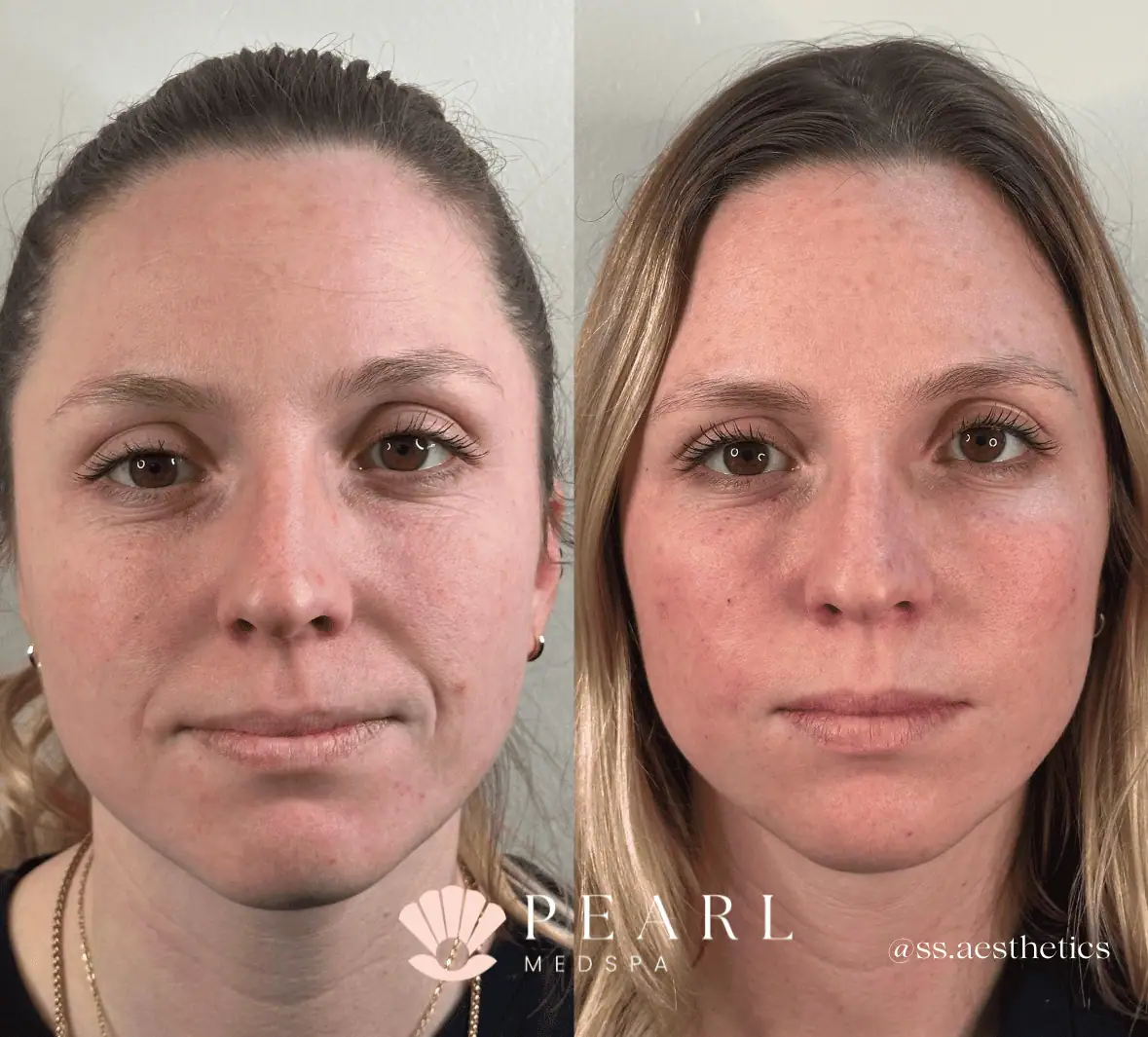PRP-Gel-Before-And-After