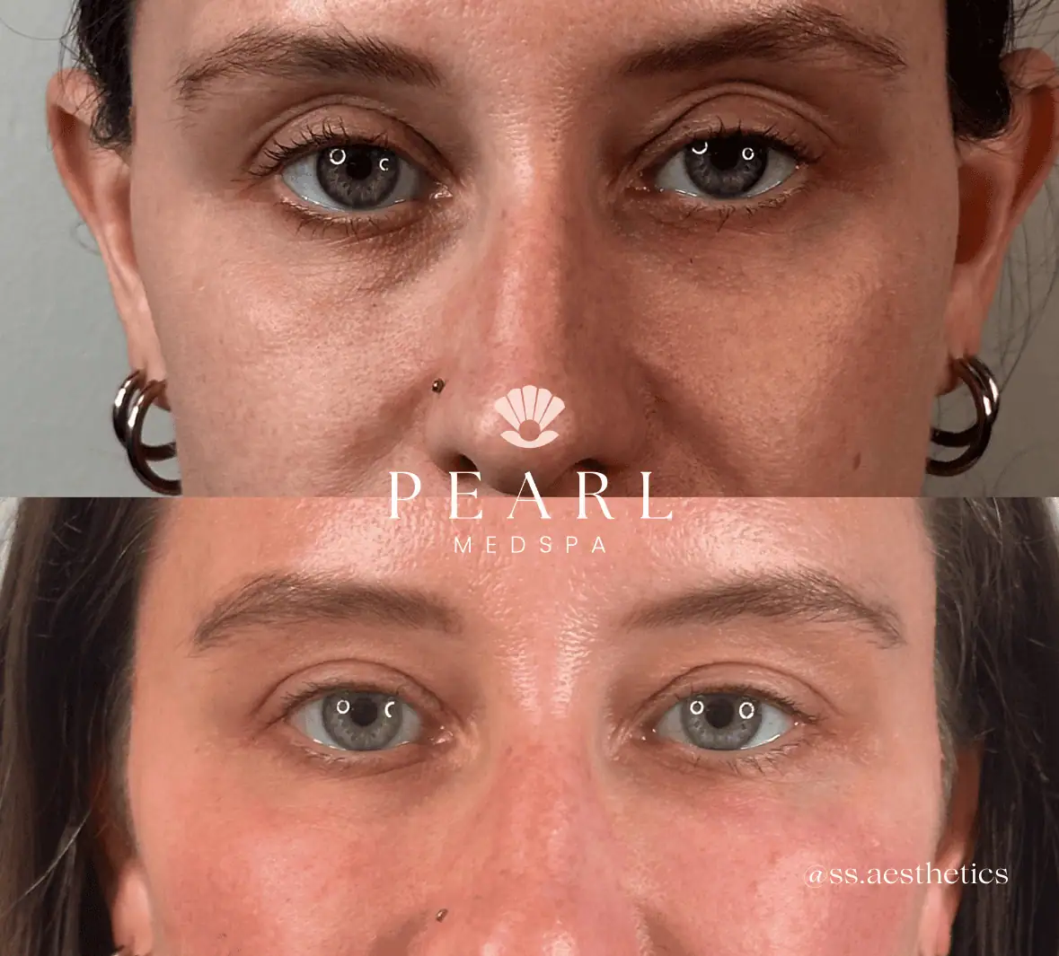 PRP-Gel-Before-And-Afters