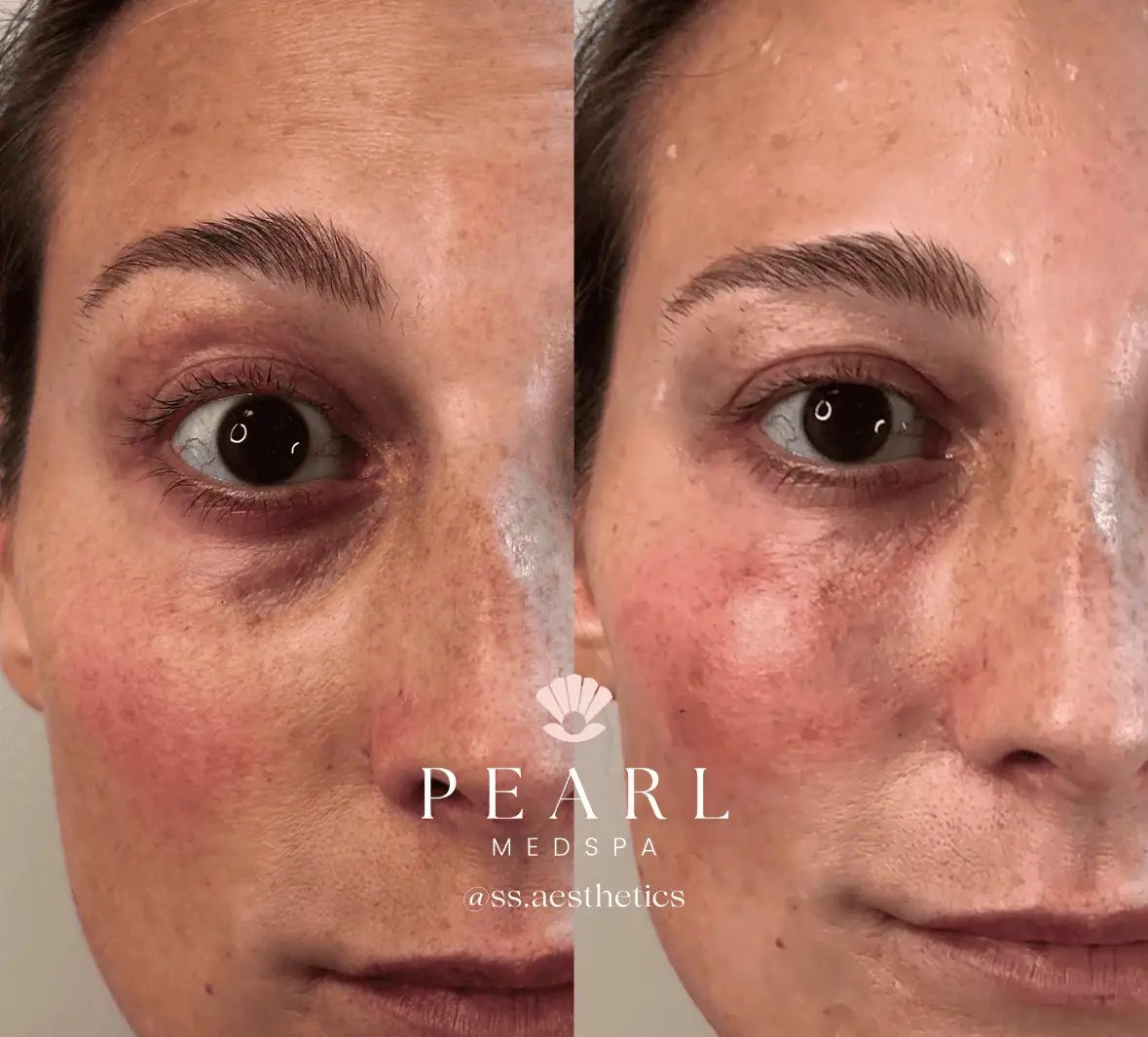 PRP-Gel-Treatment-Before-Afters