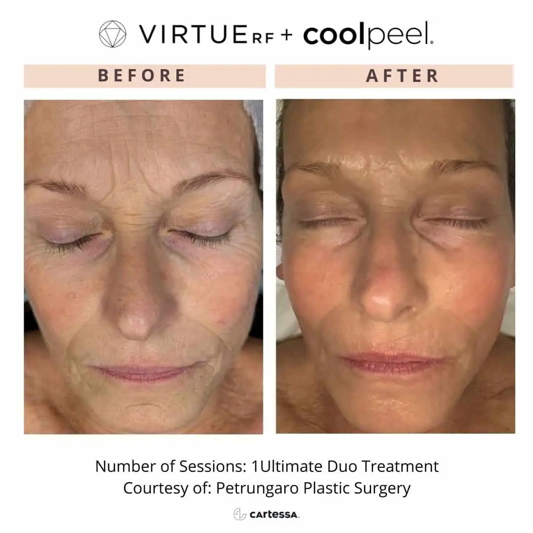 RF-Microneedling-Before-After