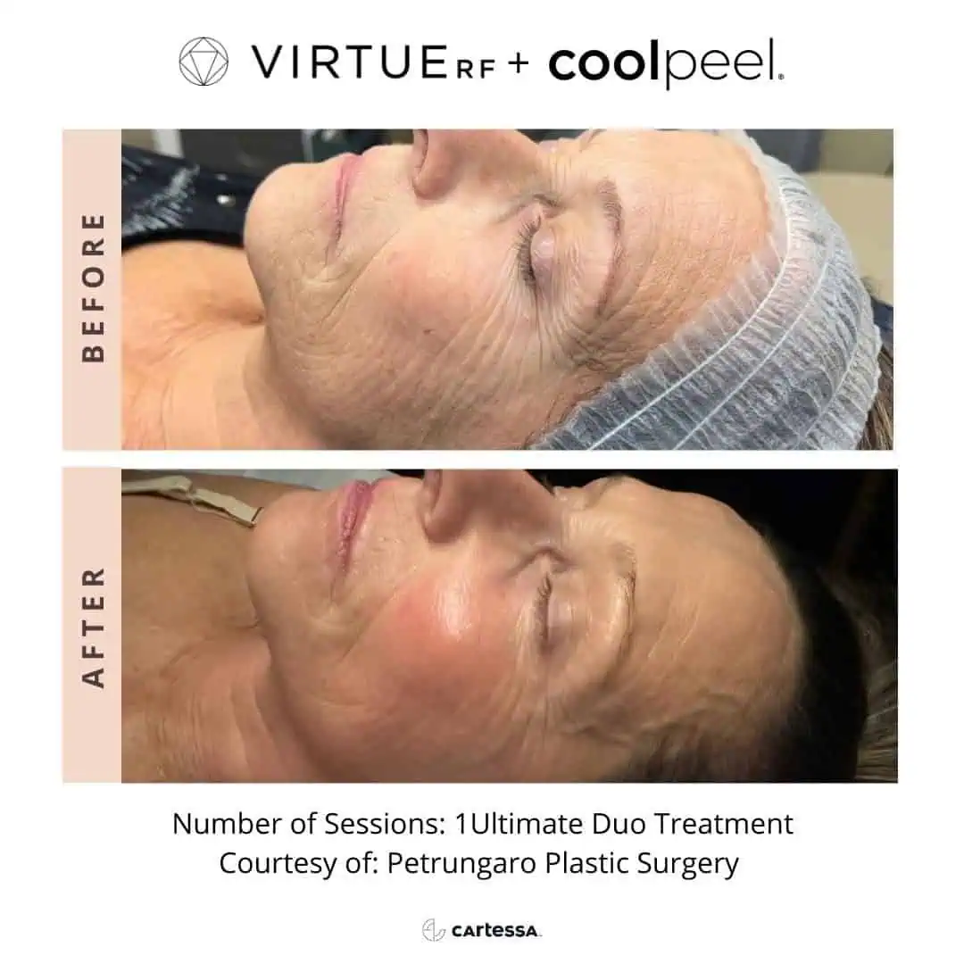 RF-Microneedling-Before-And-After