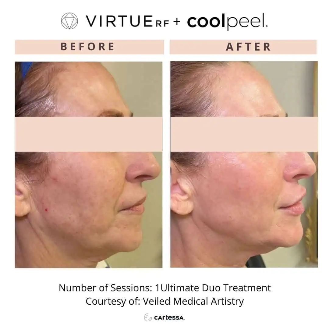 RF-Microneedling-Before-And-Afters