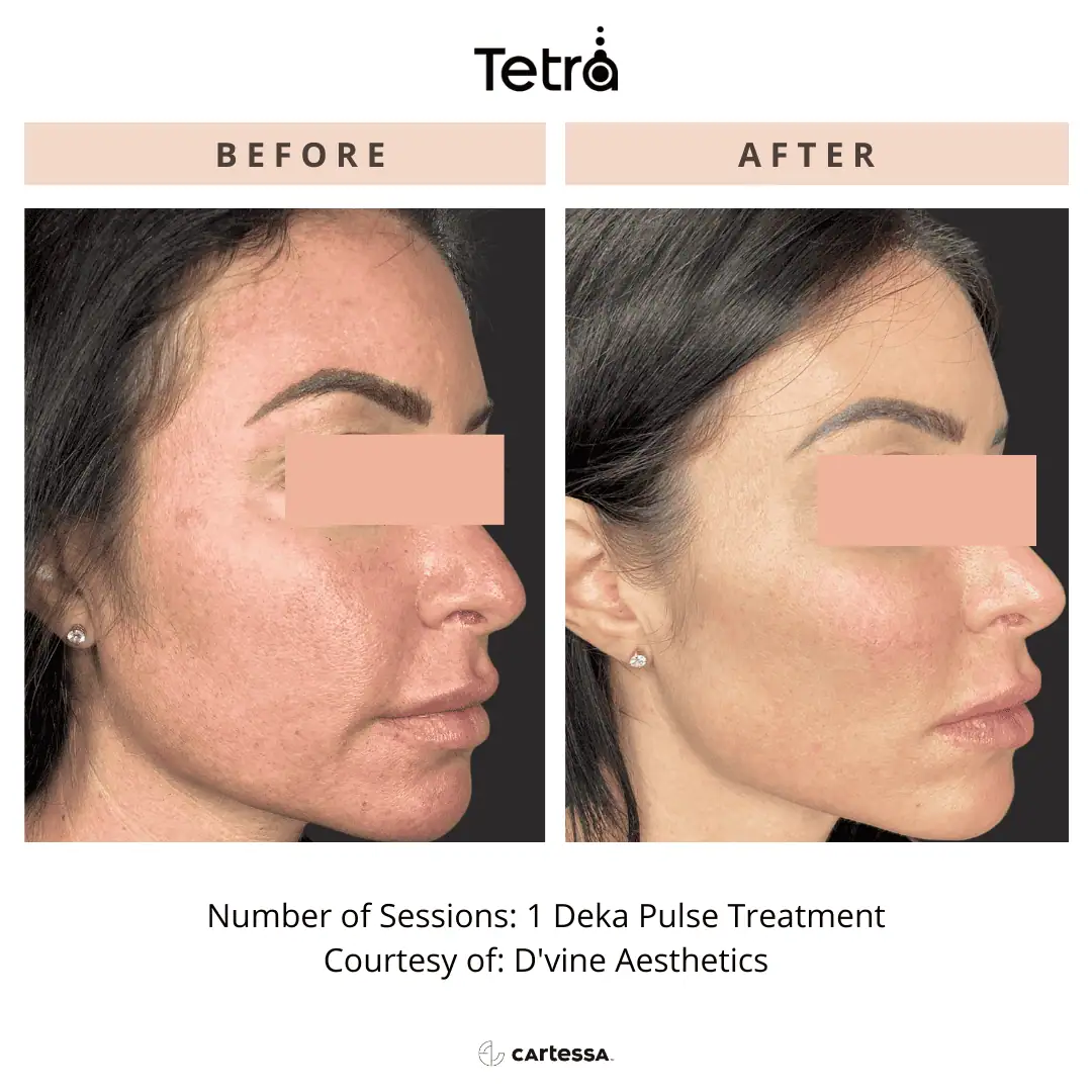 Tetra-Co2-CoolPeel-Before-After (10)