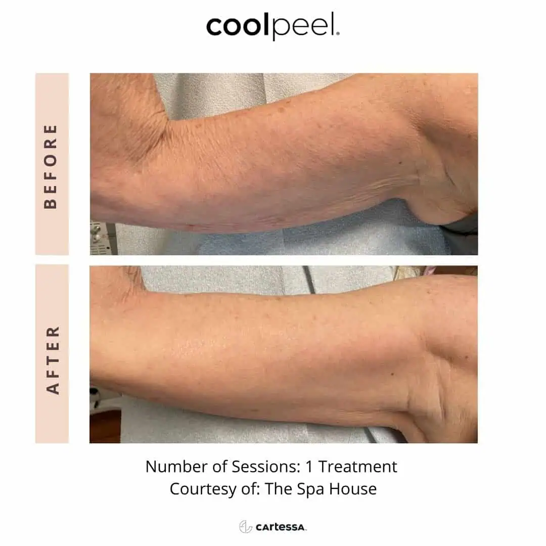 Tetra-Co2-CoolPeel-Before-After (2)