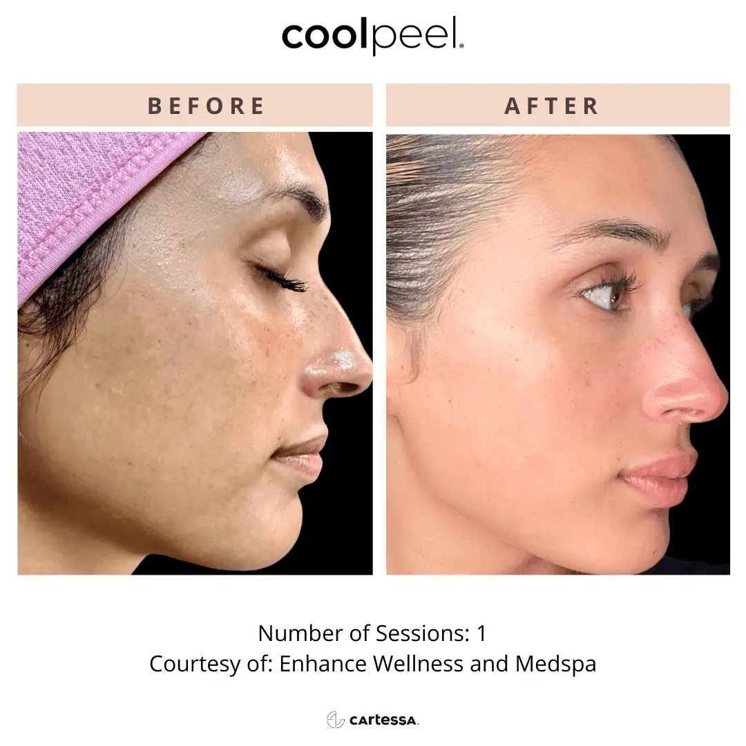 Tetra-Co2-CoolPeel-Before-After (4)