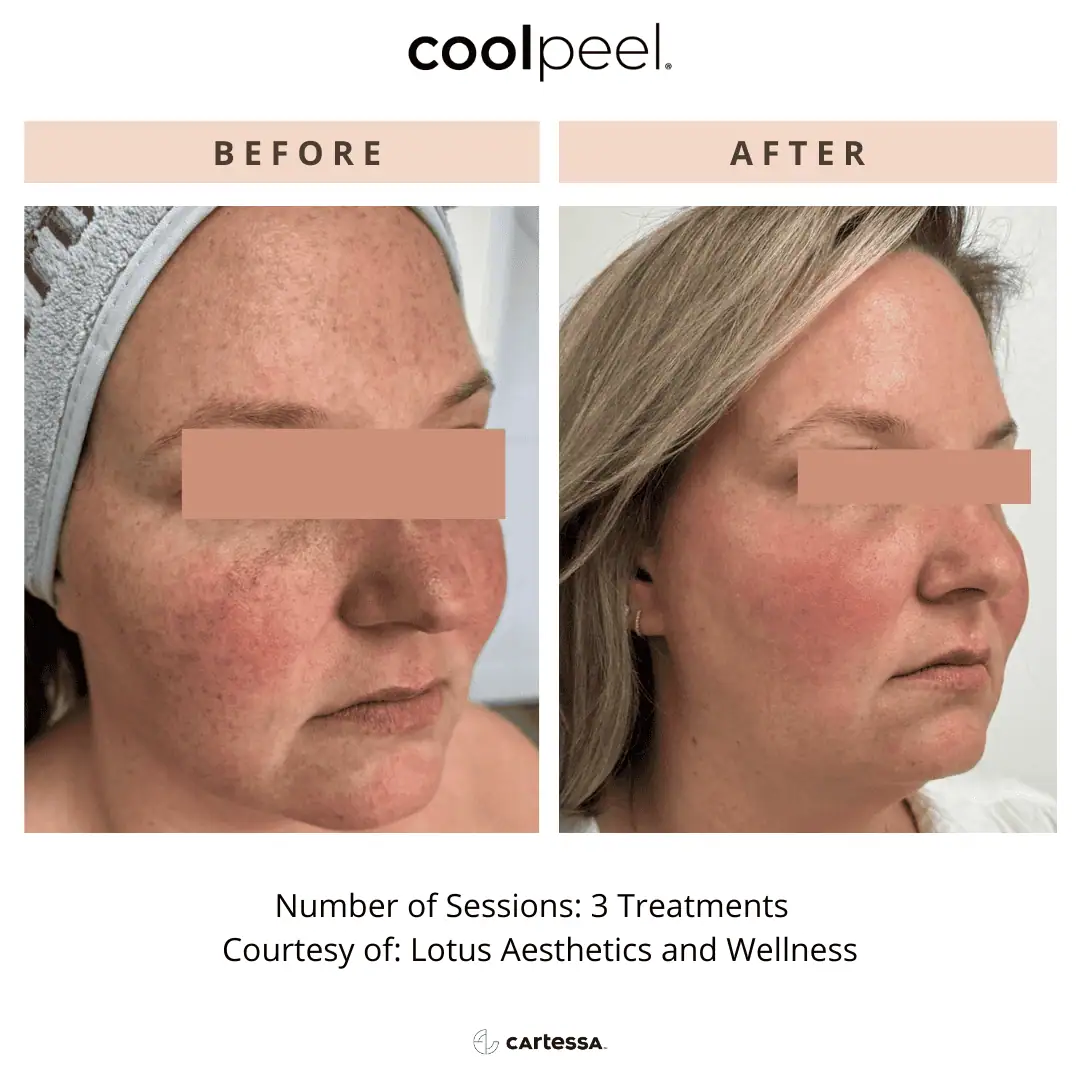 Tetra-Co2-CoolPeel-Before-After (5)