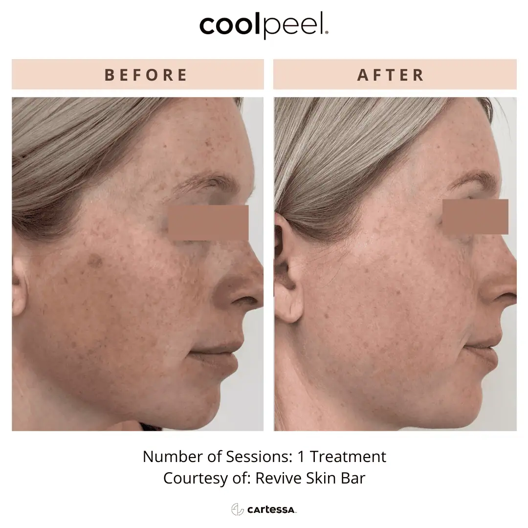 Tetra-Co2-CoolPeel-Before-After (6)