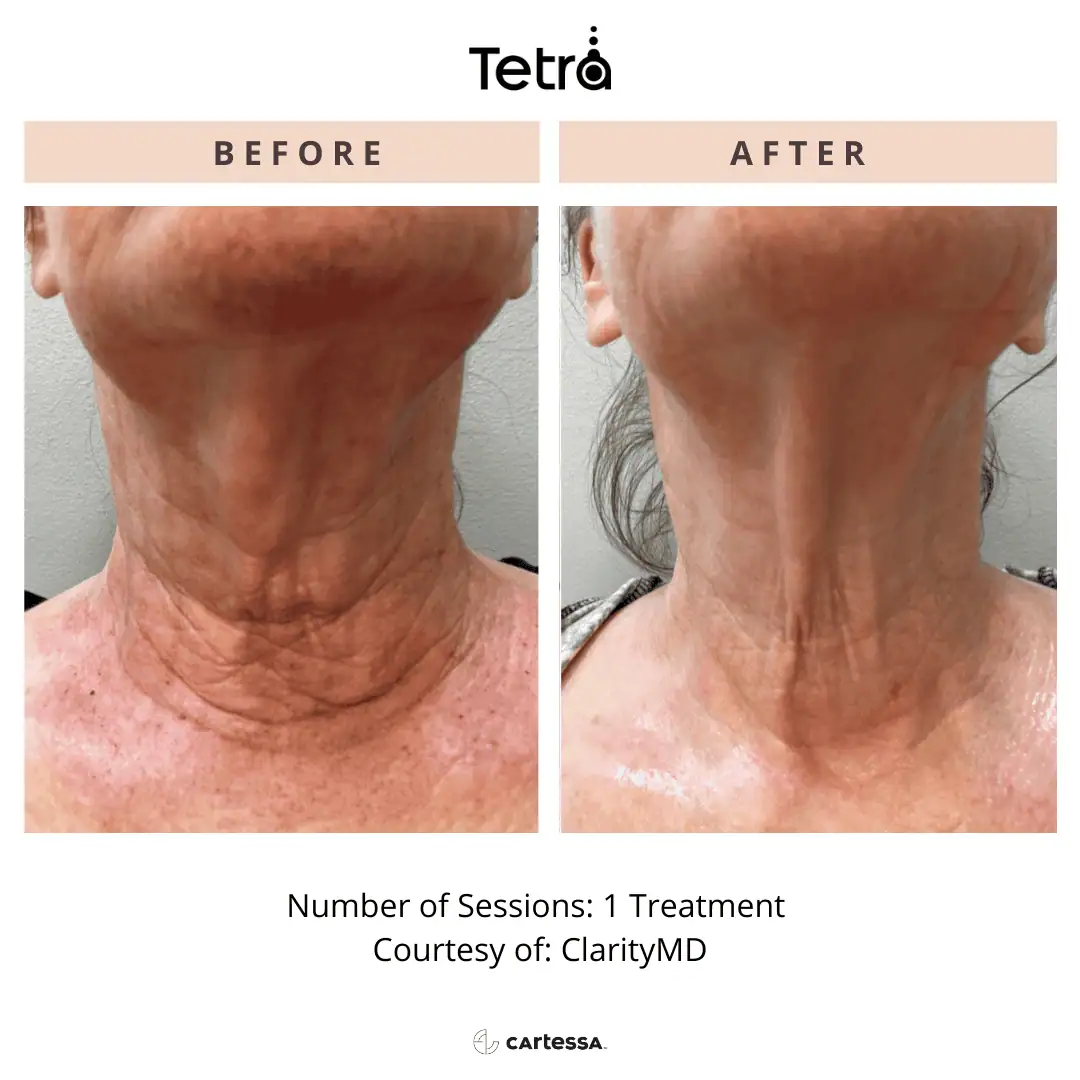 Tetra-Co2-CoolPeel-Before-After (8)