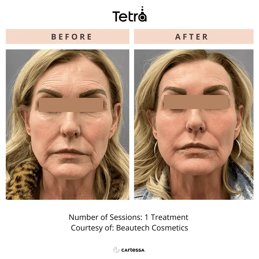 Tetra-Co2-CoolPeel-Before-After (9)