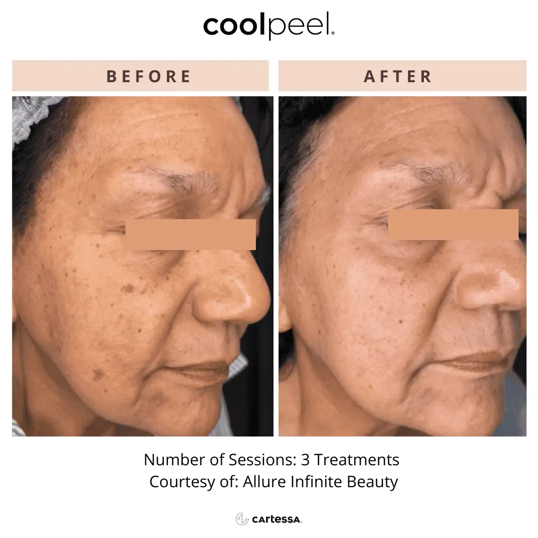 Tetra-Co2-CoolPeel-Before-After