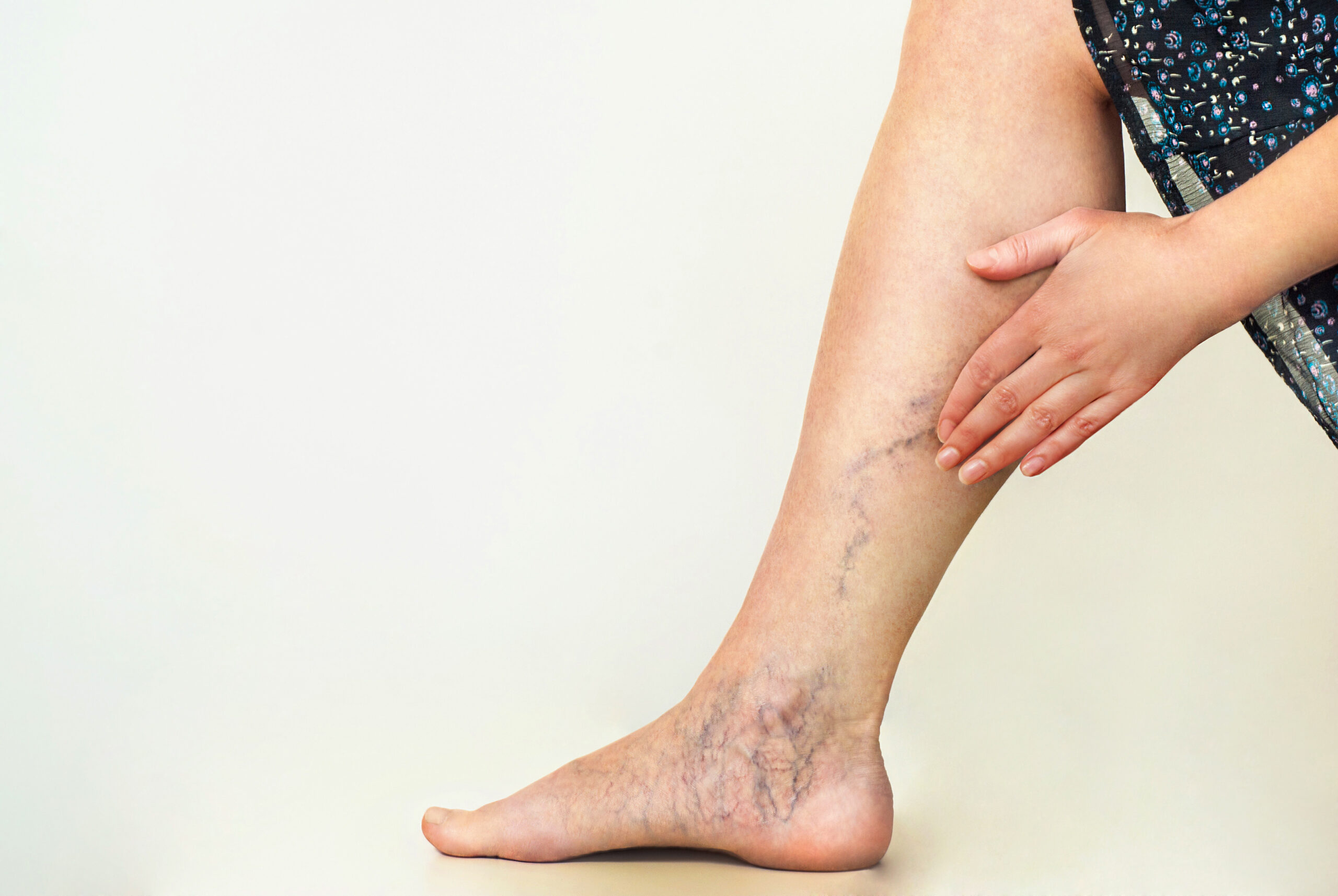 Spider Vein Removal in Charleston, SC at pearl med spa